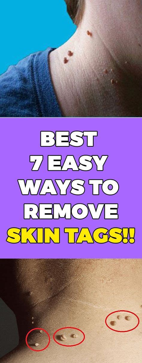 best 7 easy ways to remove skin tags body hacks skin tag removal skin tags on face skin tag