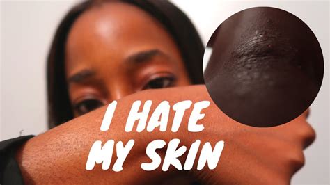 I Hate My Skin Living With Eczema Real Life Struggles Youtube