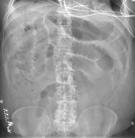 Review Of Small Bowel Obstruction The Diagnosis And When To Worry