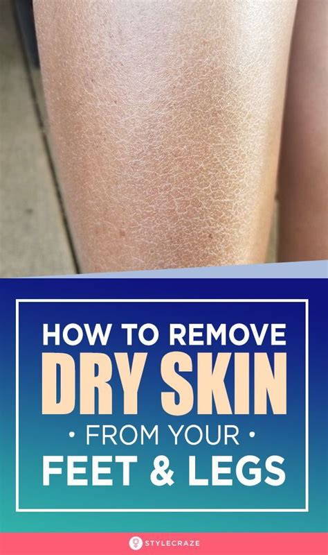 Dead Skin Under Feet Causes Symptoms And Treatment Dry Skin Legs