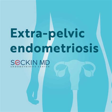 extra pelvic endometriosis seckin endometriosis center