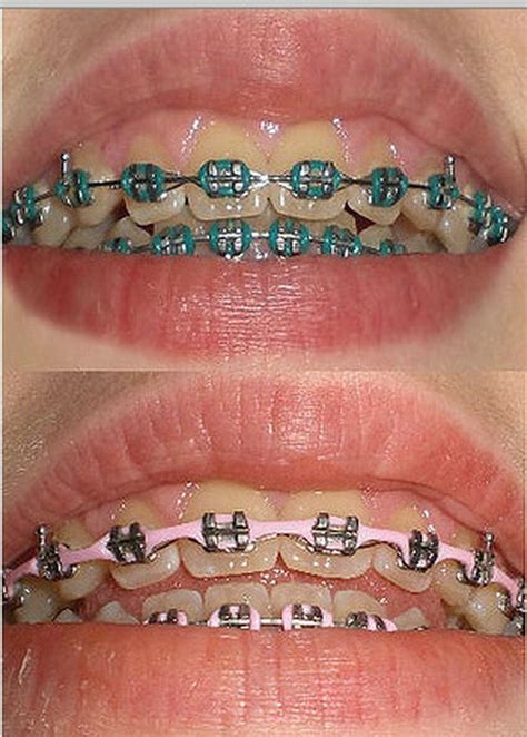 35 Best Colors To Get For Braces Png