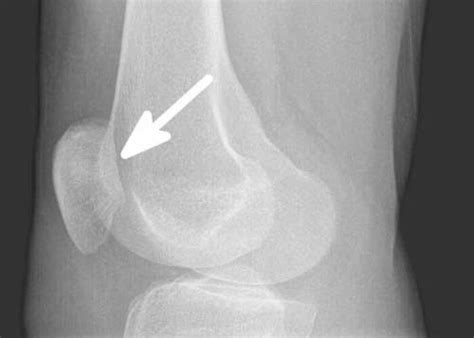 Mpfl Reconstruction Medial Patellofemoral Ligament Orthopedic Knee