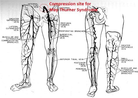 May Thurner Syndrome