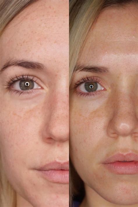 Ipl Before And After 1 Treatment Can You Wear Makeup After An Ipl