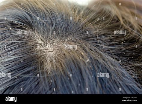 Head Lice Eggs Hi Res Stock Photography And Images Alamy