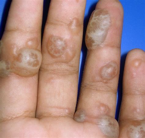 Blisters On Hands Treatment Pictures Causes Remedies