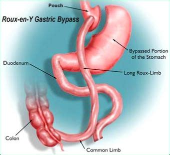 Coastal Center For Obesity Weight Loss Surgery Gastric Bypass