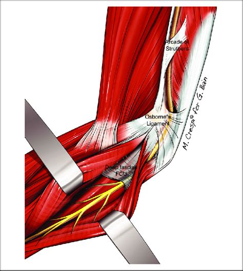 Potential Sites Of Ulnar Nerve Compression In Cubital Tunnel Syndrome