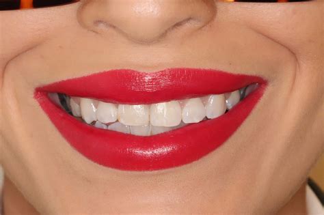 Quick Straight Teeth Adult Braces In Loughborough And Leicester