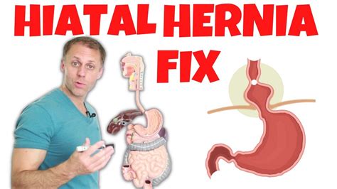 How To Fix A Hiatal Hernia Youtube