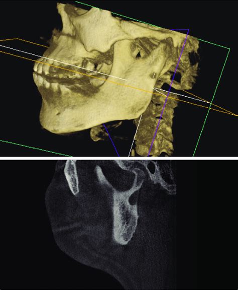A Cone Beam Computed Tomography 3 Dimensional Reconstruction Of The
