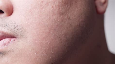 Premium Stock Video Close Up Of Skin Irritation After Shaving
