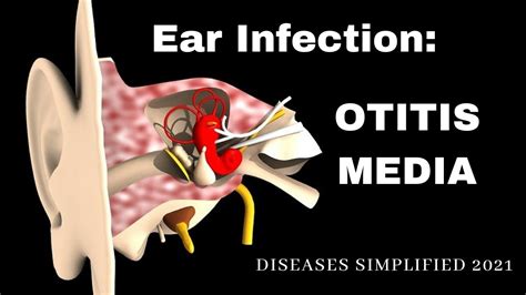 Ear Infection Otitis Media Youtube