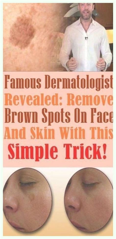 SIMPLE TRICK TO REMOVE BROWN SPOTS FROM YOUR SKIN