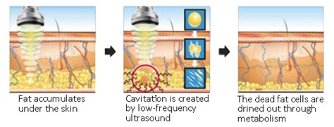 Ultrasonic Cavitation Slimming With Vacuum Rf Ultralipo Ii