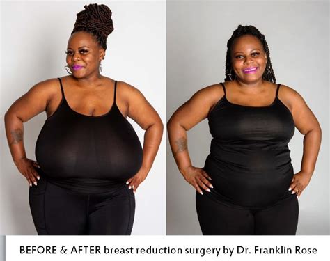 Dr Franklin Rose Reviews And Houston Plastic Surgery Blog “biggest Natural Breasts In Texas