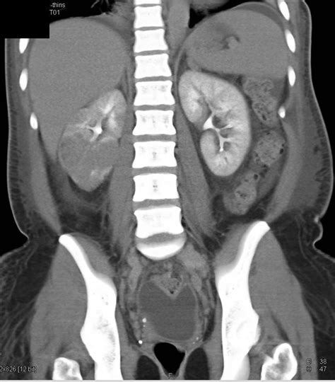 Acute Pyelonephritis Right Kidney With Blood Clots In The Ureter