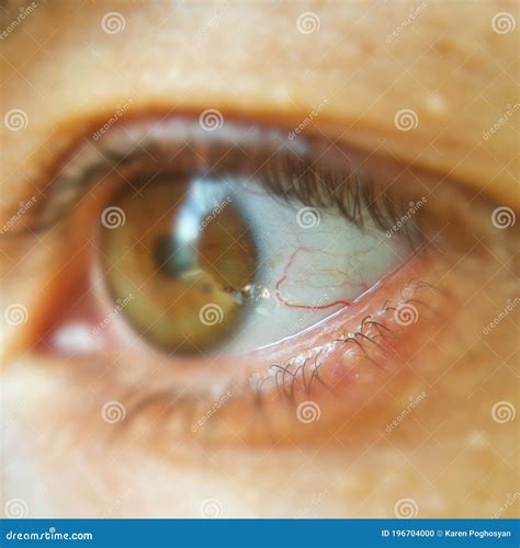 Blood Vessel On The Eyeball Selective Focus On Blood Vessels