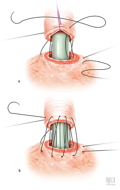 A Continuous Bladder Neckurethral Anastomosis After Open Radical