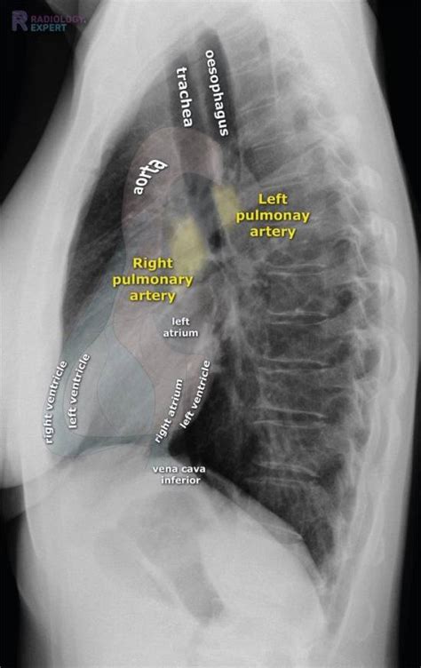 Chest X Ray