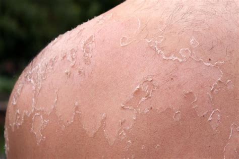 How Long Does Skin Peel After A Sunburn Skin Care Geeks