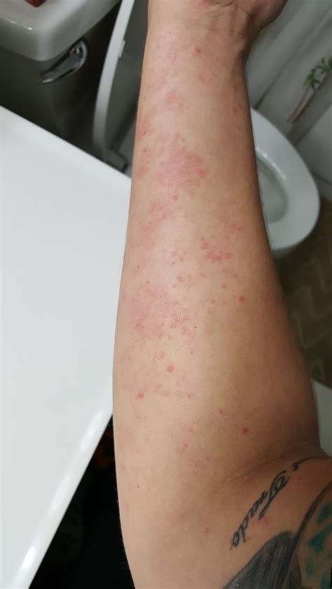 Skin Concerns Ive Had This Eczemarash On Both Arms For Years That Wont Go Away R