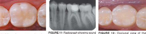 Figure 11 From Indirect Pulp Treatment In A Permanent Molar Case