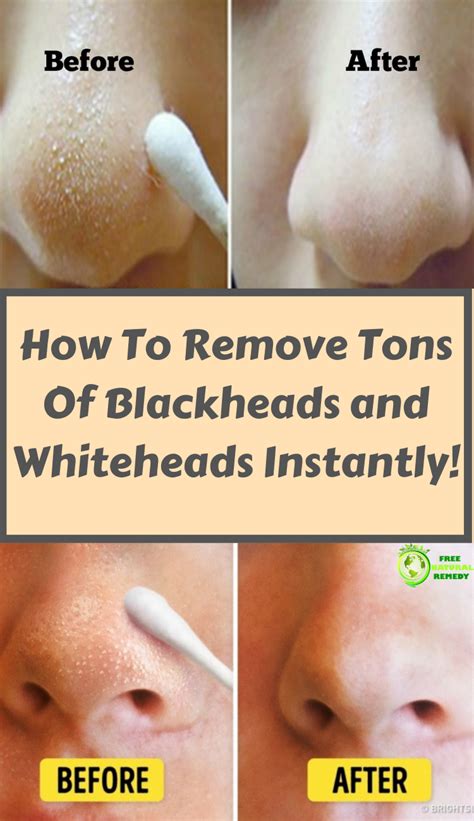 How To Remove Tons Of Blackheads And Whiteheads Instantly Blackheads
