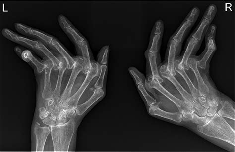 Raio X Mão Artrite Reumatoide