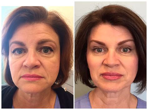 Liquid Face Lift Facial Rejuvenation Beautiful Face Medical Grade