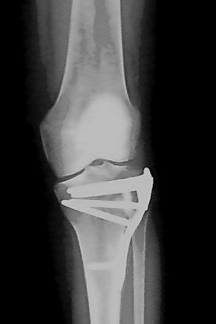 My Tibial Plateau Fracture Tpf Rehab And Recovery Tibial Plateau
