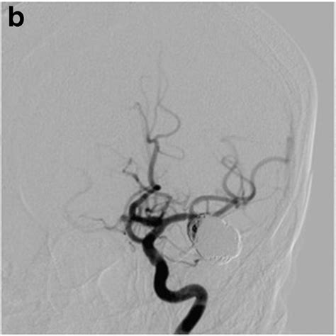 A Initial Digital Subtraction Angiography Study Of Ruptured Giant Left Download Scientific