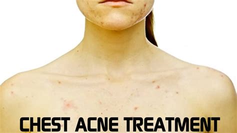 How To Get Rid Of Chest Acne Be Your Best Well Self