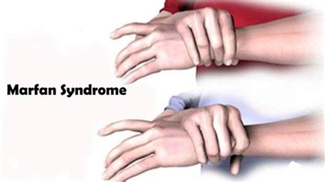 Marfan Syndrome Symptoms Causes Treatments Entirely Health