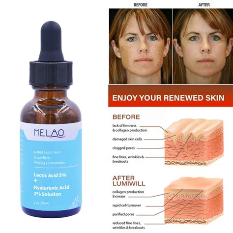 Lactic Acid Skin Peel For Face Acne Wrinkles Melasma Age Spots