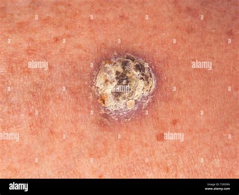 Basal Cell Carcinoma Nodular Hi Res Stock Photography And Images Alamy
