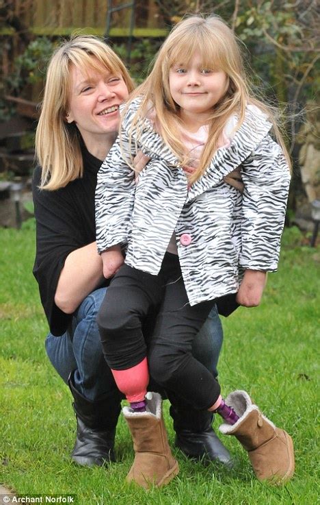 Grace Matthews Walks Again With Prosthetic Limbs After Losing Her Legs