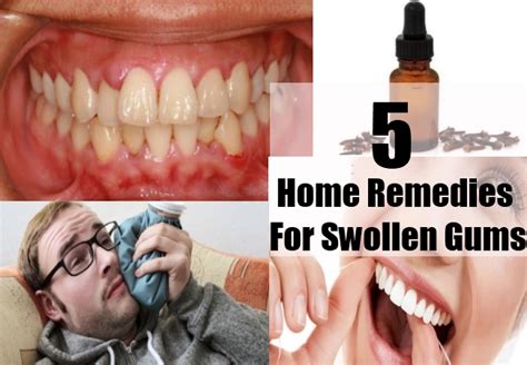 Swollen Gums Home Remedies Natural Treatments And Cure Herbal