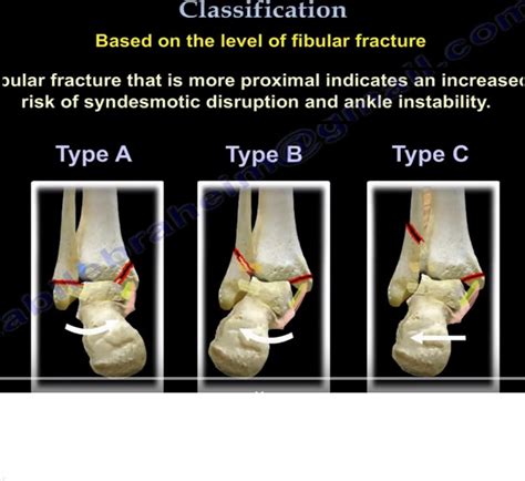 Danis Weber Classification Of Ankle Fractures —