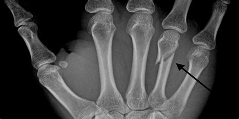 Can Hand Fractures Heal Quickly