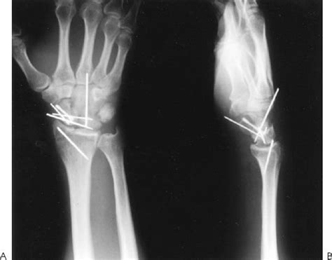 Radial Styloid Fractures Musculoskeletal Key