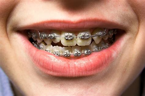 How Much Does It Cost To Get Dental Braces And Invisalign In Singapore