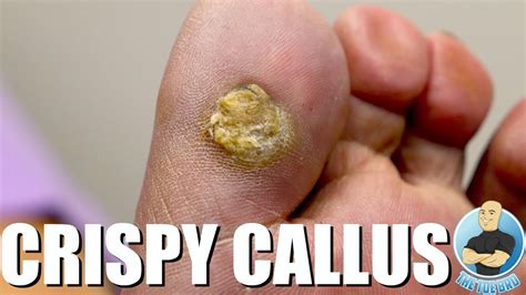 Scraping Off A Huge Toe Callus Youtube