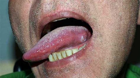 White Bump On Tongue Cancer