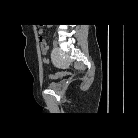 Extramedullary Hematopoiesis Presacral Mass Image