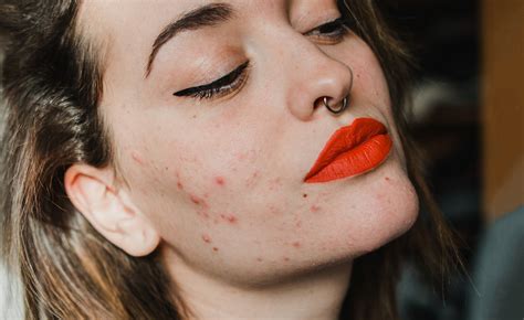 6 Skincare Remedies To Treat Hormonal Acne At Home Beautylish