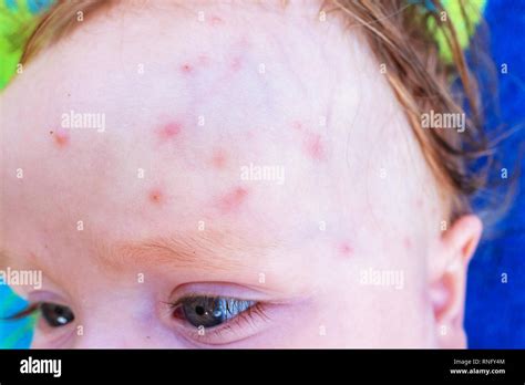 Mosquito Bites On The Forehead Of A Small Baby In Summer Stock Photo