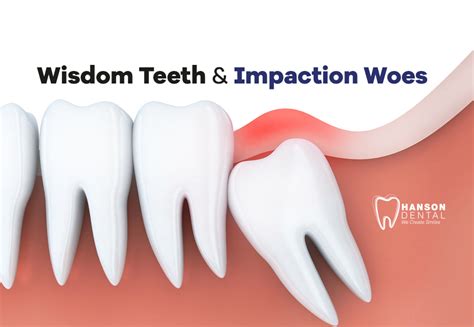 Wisdom Teeth And Impaction Woes Hanson Dental Dentist In Buffalo Mn
