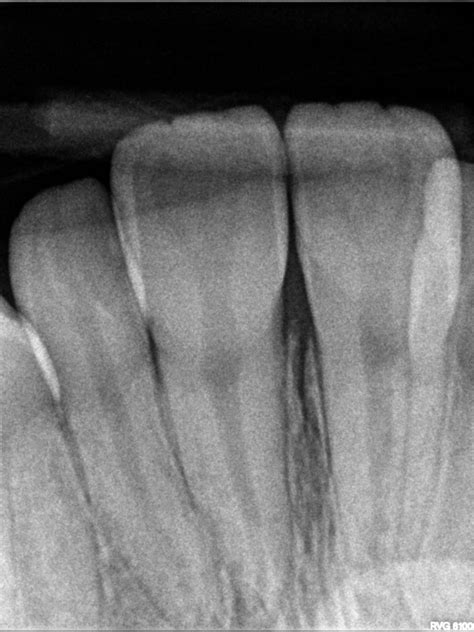 What Are The Different Types Of Digital Dental X Rays Palms Dentist